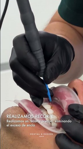 ¿Has visto como se realiza un recorte de encias?