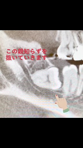 下の親知らずの抜歯です！#親知らず #歯科 #抜歯