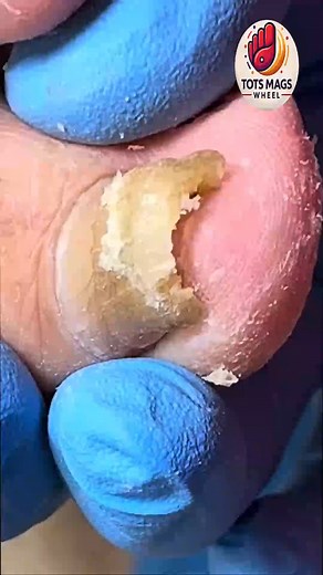 17K views · 185 reactions | Effective Toenail Support for Ingrown Nails That Reduce Pain Naturally  #HealthyHabits #SafeSteps #WellnessSeniors | Tots Mags Wheel | Facebook