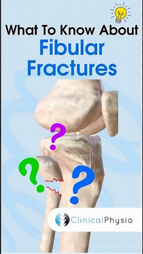 Fibular Fractures #anatomy #physiotherapy #physicaltherapy #fibulafracture