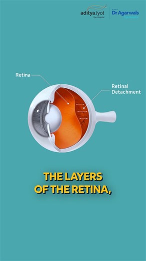 1.2K views · 16 reactions | Retinal detachment can threaten your...