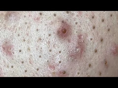 Blackhead removal with NaSa Spa | Satisfying and Relaxation with NaSa Beauty Spa