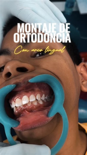 Dr. Pedro Ramirez👨🏻‍⚕️ on Instagram: "¡Ortodoncia con arco lingual en ODONTOSPECIAL! . Alinea tu sonrisa de forma discreta y efectiva. El arco lingual trabaja desde el interior, corrigiendo la posición de tus dientes sin que nadie lo note. ✔️ Precisión ✔️ Comodidad ✔️ Resultados visibles . Porque una sonrisa bien alineada no solo se ve… se siente 😁 Agenda tu valoración y da el primer paso hacia la sonrisa que mereces."