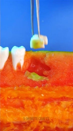 How Dentists Treat Wisdom Tooth Problems 😳🦷 #5minutebeat