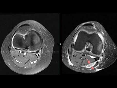 Leaking or ruptured popliteal cyst