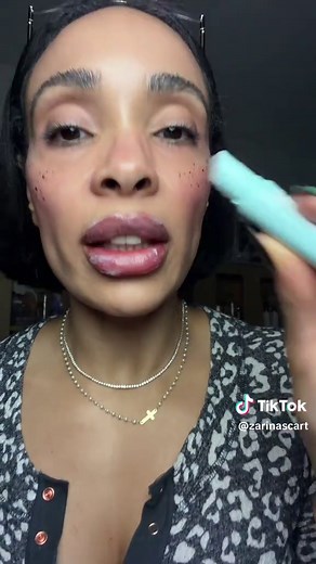 Understanding Peeling Lips and Remedies