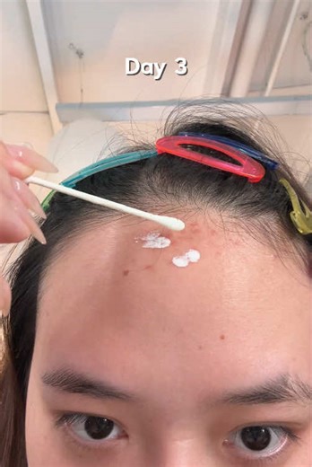 Effective Spot Treatment with Salicylic Acid