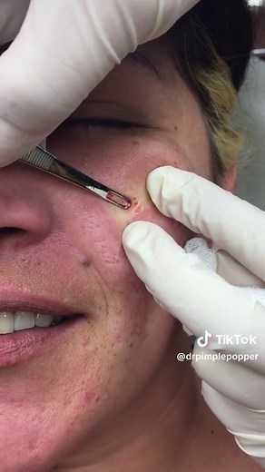 Something tells me you need to see how all this happened, so let’s bring one extraction back from the past. And spread a little happiness 🥰 #drpimplepopper #breakingout