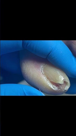 Super-Curled, Sharp-Edged Armor! #foot #nails