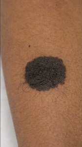 I Found A Halo Around My Mole And This Is What Happened
