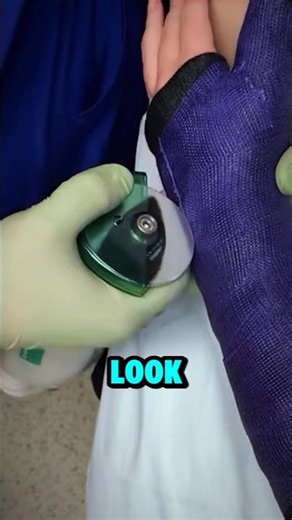 Why Doctors Use a “Saw” to Remove Casts (And It’s Safer Than It Looks)
