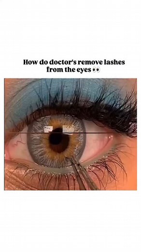World of Biology on Instagram: "Doctors carefully remove eyelashes from the eye using gentle and precise methods to avoid irritation or injury. They first examine the eye under bright light or a slit lamp to locate the lash. If it’s loose, they may flush it out with sterile saline solution. If the eyelash is stuck, they use a moistened cotton swab or fine, sterile tweezers to lift it away carefully. In cases where the lash is trapped under the eyelid, they may gently flip the lid inside out for