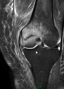 Stress Fracture Knee