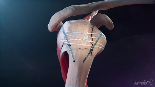 FxBridge™ Tuberosity Repair System: Reverse Total Shoulder Arthroplasty