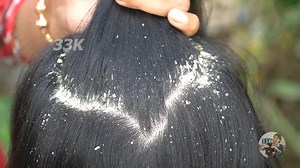 19K views · 163 reactions | Extreme Damage Dandruff on Long hair guy - Itchy Dry scalp - Combing and scratching 722 | 33K | Facebook