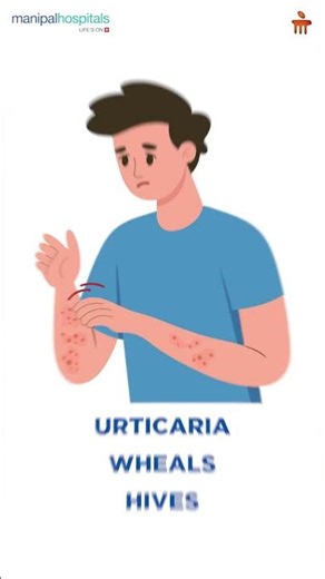 Red, Raised, Itchy Rashes| Dr. Ankur Jindal Explains Urticaria | Manipal Hospital Old Airport Road