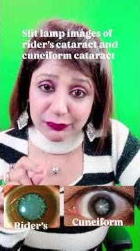 #slit lamp images of rider’s cataract and cuneiform cataract #neetpg2026 #inicet2025 #dbmcione #fmge