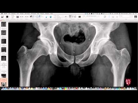 Bassin et hanches - radiographie essentielle • Vidéo • Site médical MEDtube.fr