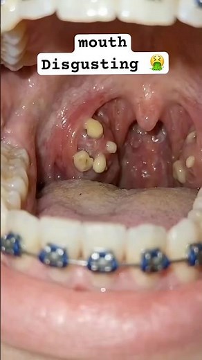 Disgusting stinky Mouth reason 🦠😷🤮