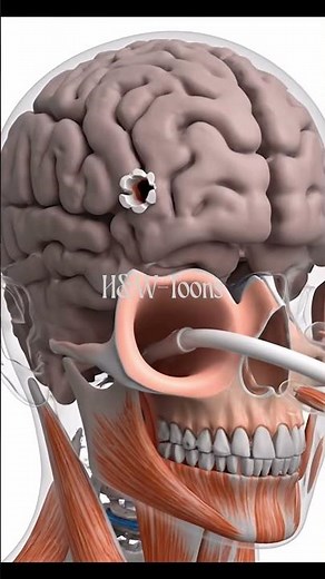 HYDROCEPHALUS: Shunting Excess Fluid #Hydrocephalus #BrainPressure #VentriculoperitonealShunt
