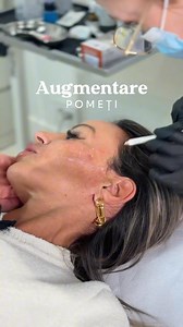 Cheekbone Lifting – Restore Volume, Contour, and Freshness to Your Face Cheekbone lifting is a minimally invasive procedure designed to redefine facial contours, lift the cheek area, and restore the volume lost over time. Using precise injections, it offers a natural lifting effect without surgery or long recovery periods. This procedure: • enhances your natural facial features with a rejuvenated look; • lifts and restores volume to flat or sagging cheekbones; • sculpts the upper face for a more