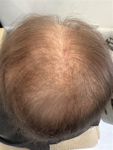 Effective Solutions for Female Hair Loss