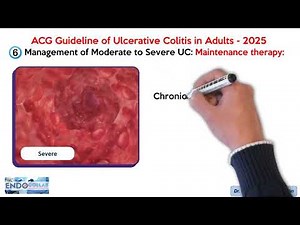 ACG Guideline of Ulcerative Colitis in Adults - 2025