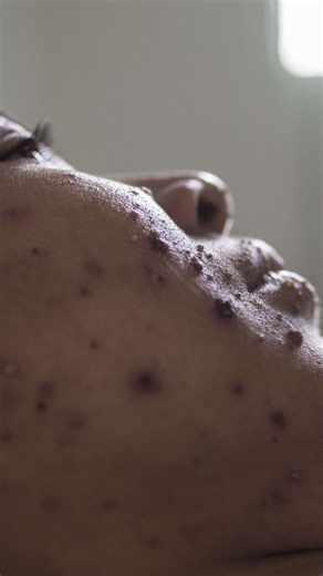 Measles in Shasta County and what to do about it