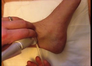 Ultrasound Guided Posterior Tibial Tendon Injection