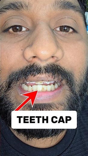 Teeth Capping #capping #zirconia #dentist