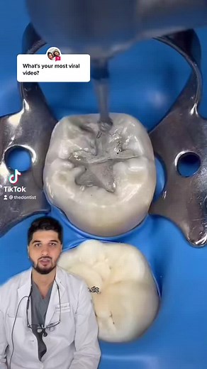 Removing Old Silver Fillings: Dental Procedure with Amalgam