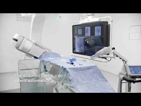 Simplifying and advancing 3D imaging with SmartCT in aneurysm flow diverter