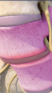 4.8K views · 59 reactions | Need to understand degenerative spondylolisthesis and how it causes back pain, leg pain, and nerve compression? 領 This video explains the symptoms, causes, and treatment options for spinal instability, including surgery and non-surgical care.  Perfect for anyone researching lower back pain, spinal stenosis, or slipped vertebra. ✅ | Spine-health | Facebook