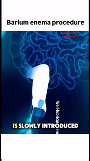 Barium Enema Procedure: What Really Happens Inside Your Colon During This Diagnostic Test #shorts