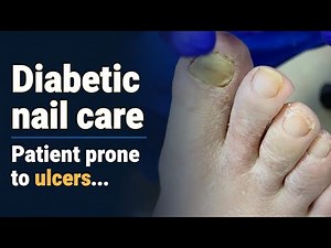 Cutting the diabetic toenail of an ulcer prone patient