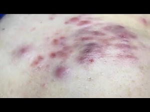 Massive Cystic Acne Breakout | Deep Pus & Blackhead Removal, Relax your mind.