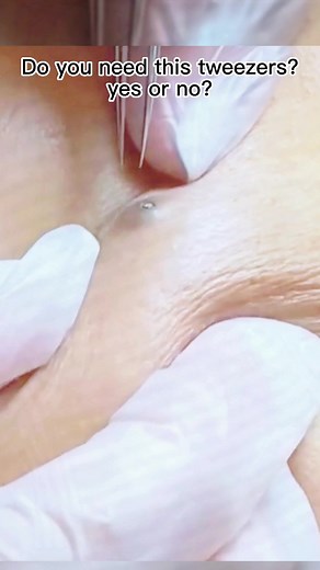 #pimplepop #acnetreatment #pimple #acne #pimplepopper #pimplepopper2021 #satisfyingvideo #cystpopping #pimplepopper2022 #skincare #fyp #removal