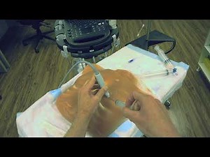 Pericardiocentesis POV