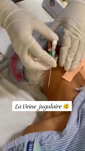 Nurse Houssam ‍⚕️ on Instagram‎: "Catheter jugulaire  . . . . . . . . . . . . . . . . . . . . . . . . #vaccin #paramedical #nursing #infspm #isp #ats #Infermier #paramedicaux #nurselife #dz #assp #mimsp #infspm #Réponses #dz #mimsp #ممرض #تمريض#مصطلحات_طبية #ممرضين #الطب #طبيب #ممرضين #الطب #قابلة #تخذير #انعاش #ادوية #تمريض #مصطلحات_طبية #فرملية #فرملي"‎