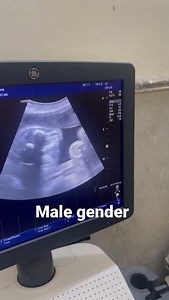how to see gender on ultrasound