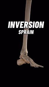 994 reactions · 10 comments | An ankle sprain is usually caused by an...