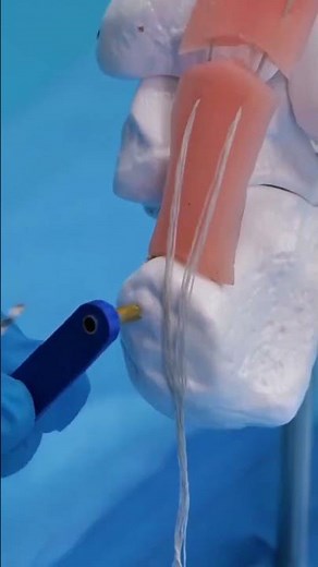 How Surgeons Fix a Torn Achilles Tendon (Wait for the BONE DRILL 🦴)