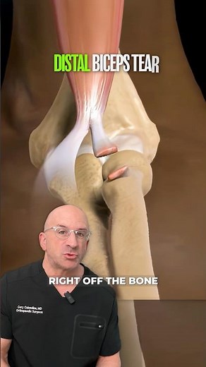 Don’t Miss These Biceps Tear WARNING Signs ⚠️
