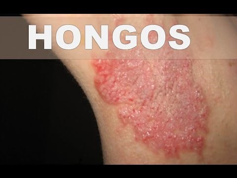 Secretos caseros para las infecciones por hongos – Como reducir las infecciones por hongos en piel