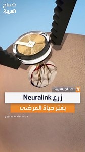 309K views · 6.1K reactions | تمنح الأمل لمرضى الشلل.. طريقة زرع شريحة Neuralink في الدماغ #صباح_العربية | صباح العربية - Sabah Al Arabiya | Facebook