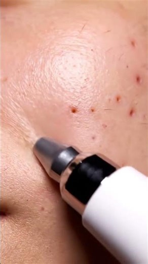 Deep Pore Cleaning on Cheek 😳 Ultra Clean 4K