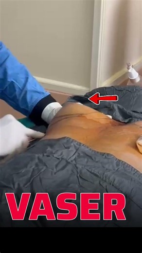 Botched Liposuction Turned Into This #before&after #shocking