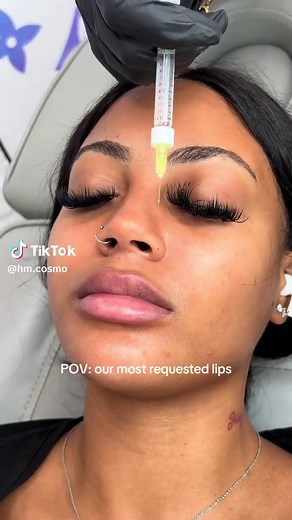 Full & Flat Lip Filler: 2026 Clients Love This Shape