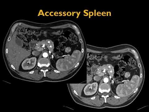 CT Evaluation of the Spleen: Challenges in Diagnosis Part 1