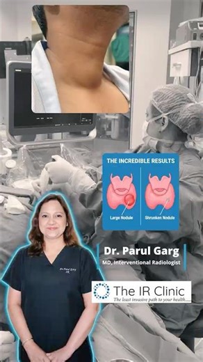 Thyroid Nodule Treated Without Surgery ✅ | Dr. Parul Garg #ThyroidNoduleAblation Case